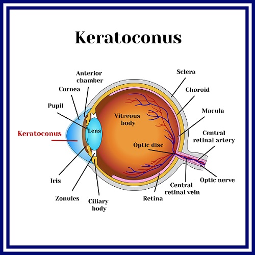Keratoconus