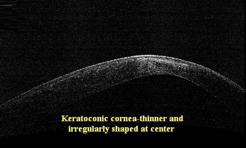 Keratoconic Cornea