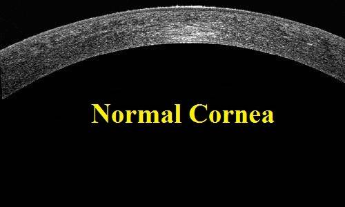 Normal Cornea